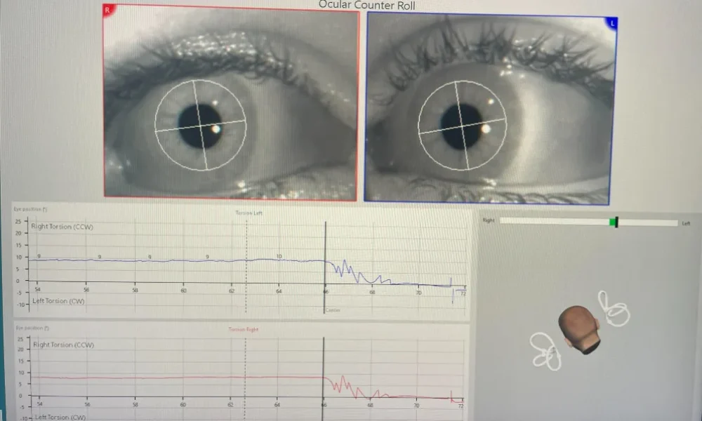 ocular counter roll